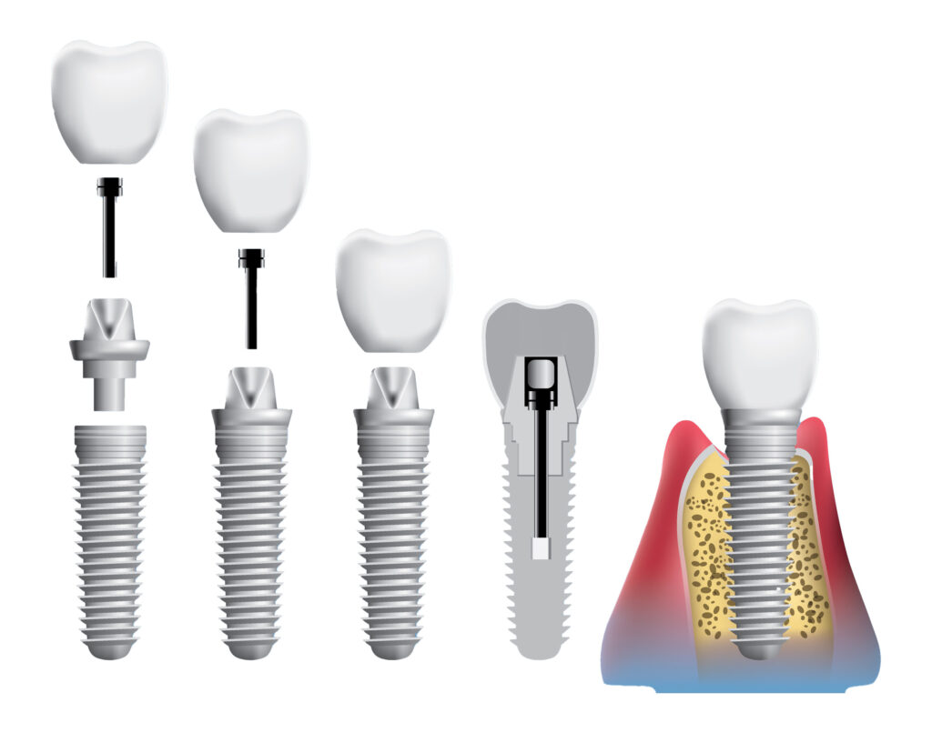 implant treatment